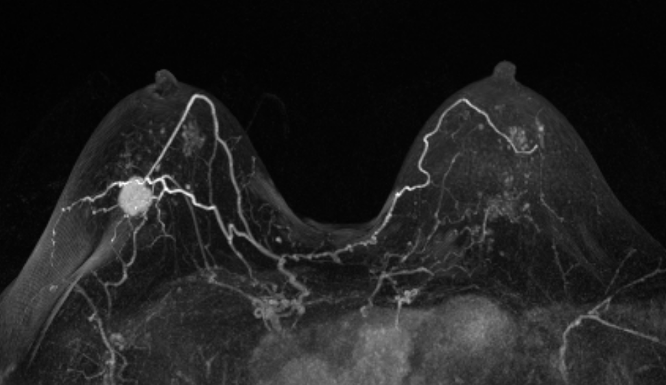 MRI Breasts - Centres and Services - St. Paul's Hospital